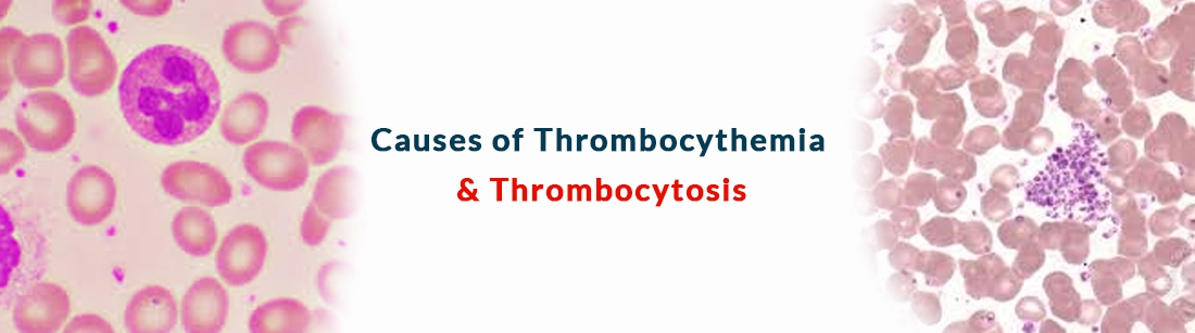 Causes of Thrombocythemia & Thrombocytosis